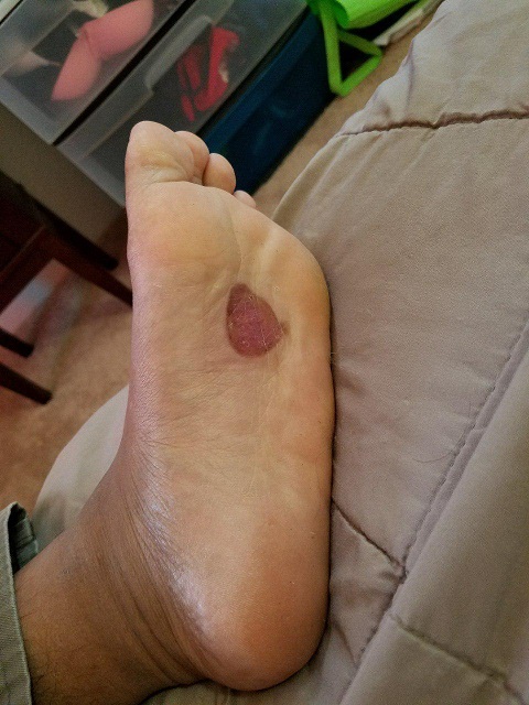 burn-blister-2